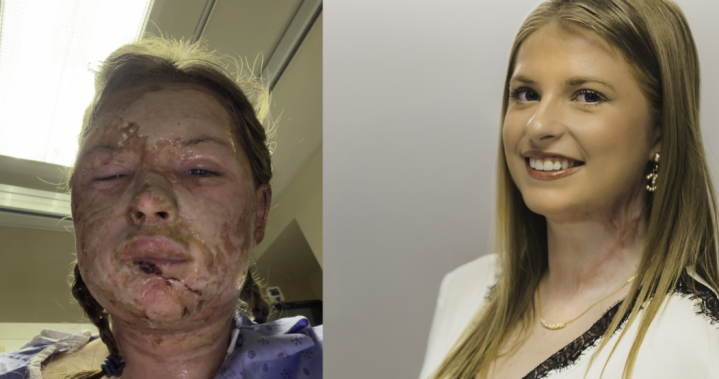 World-first burn treatment shows ‘remarkable’ results in Canadian patient